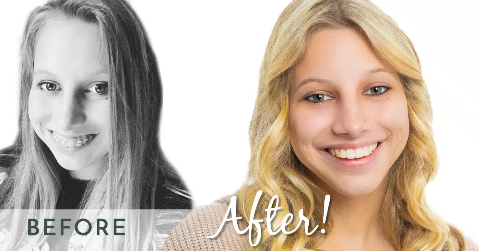 Before and After Braces Face Shape — Shoe Orthodontics Hanover, PA