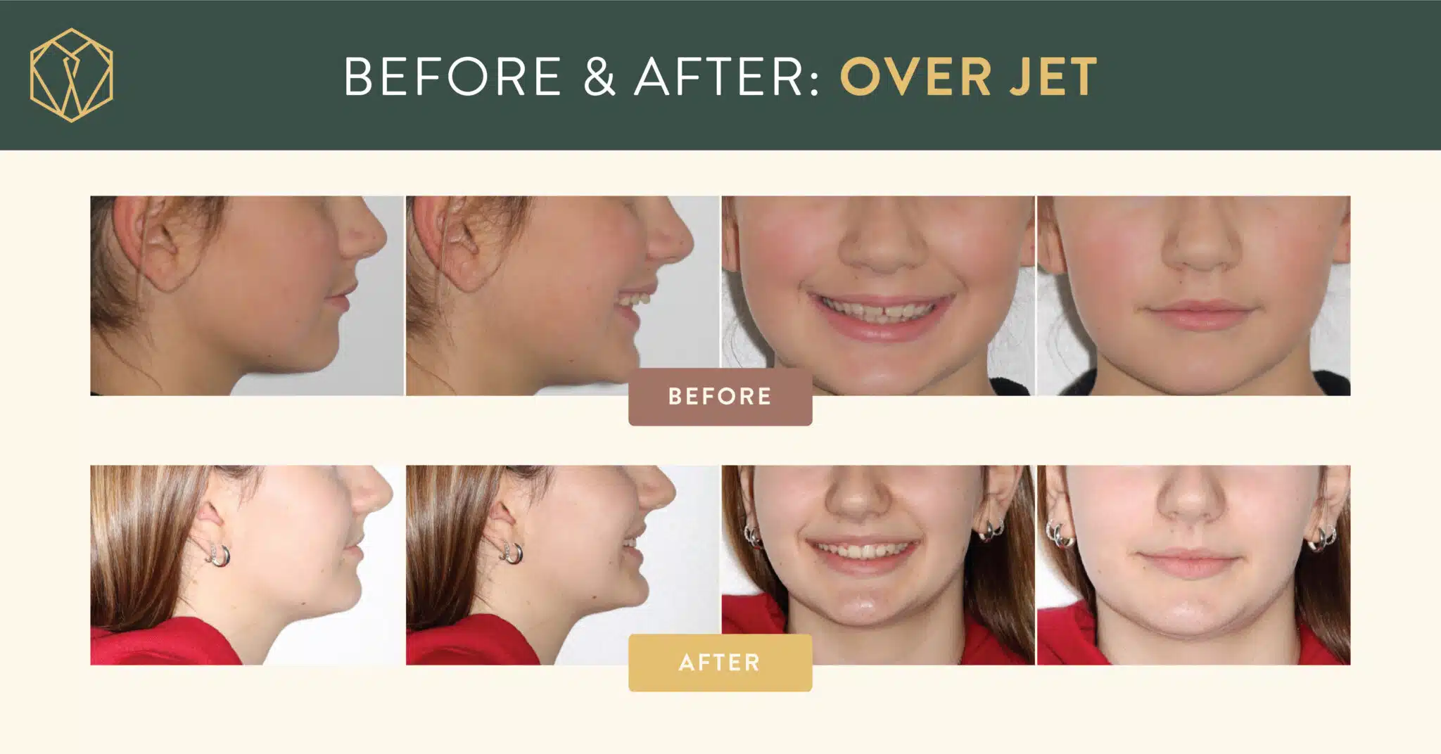shoe beforeafter jacquelyn overjet 1