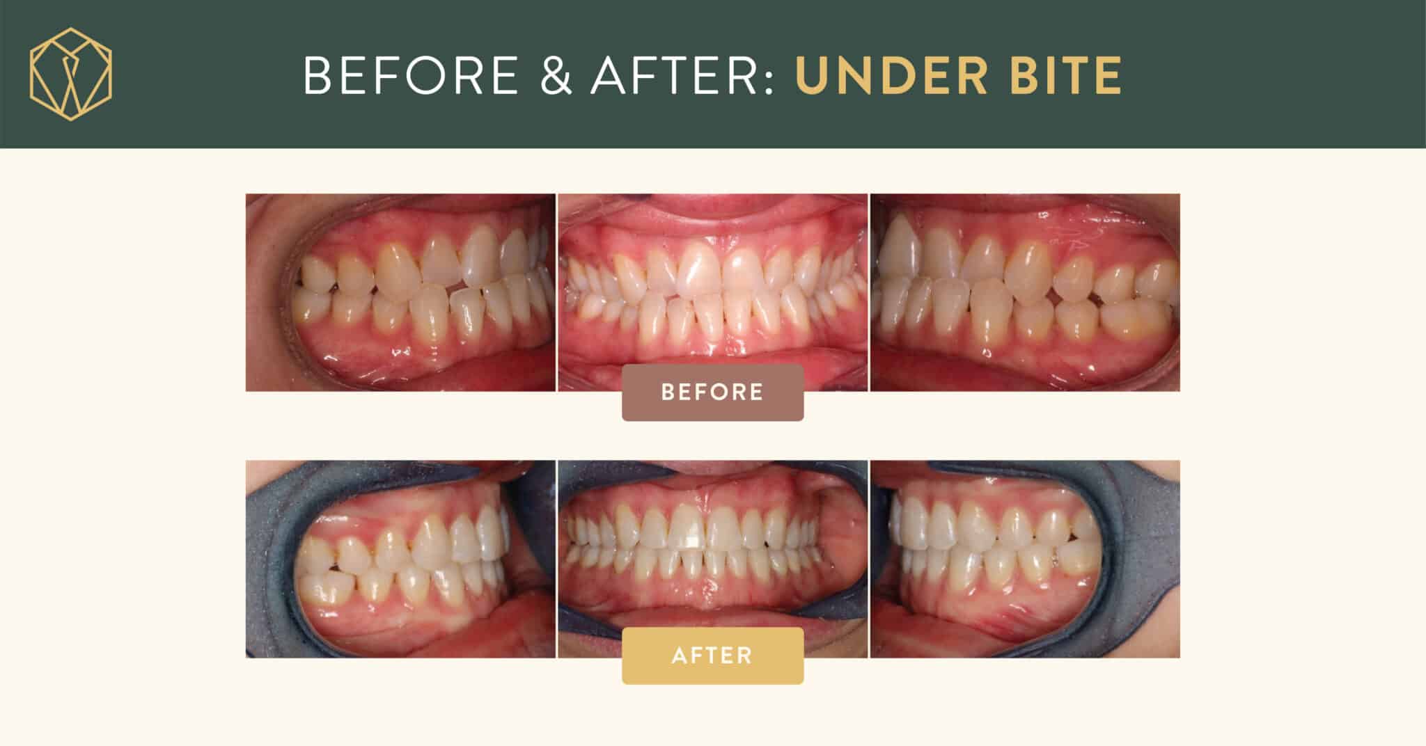 shoe beforeafter underbite kimberly 2 1